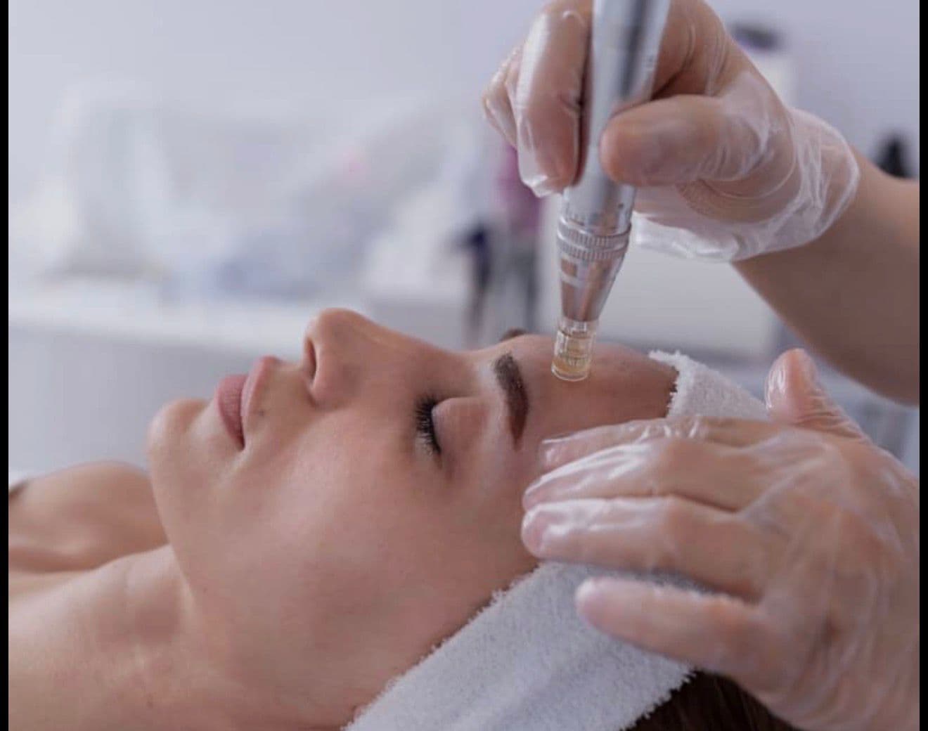 Microneedling