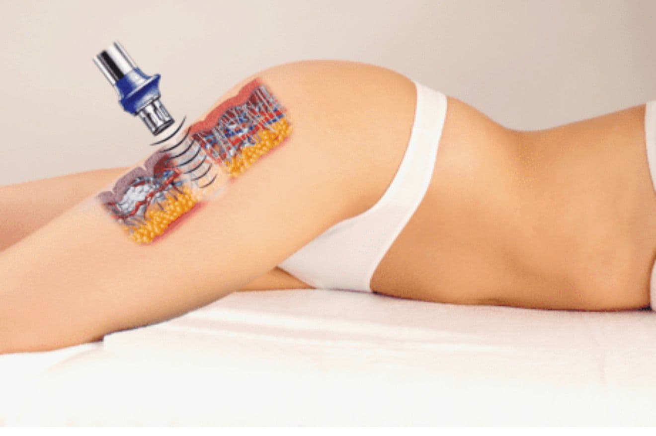 Ondes de choc X-Wave